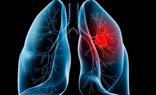 cáncer pulmonar