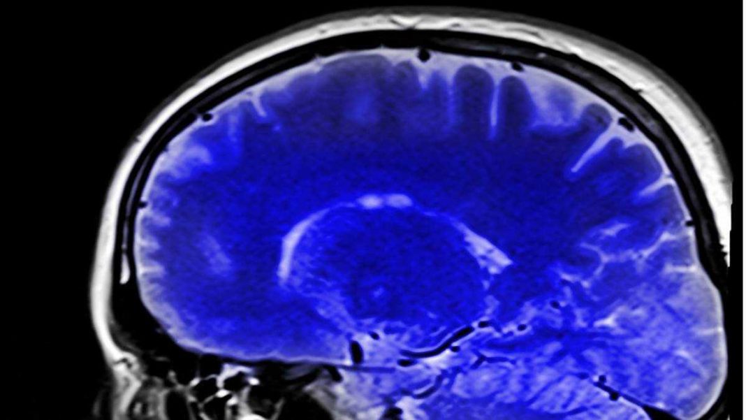 tumor cerebral